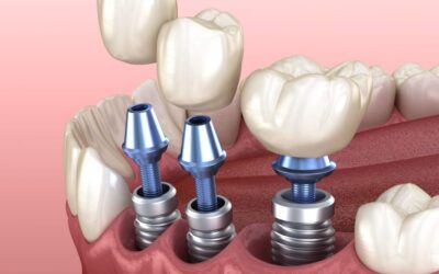 Критерии выбора при имплантации зубов