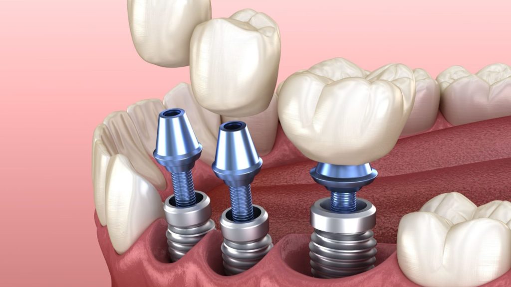 Критерии выбора при имплантации зубов